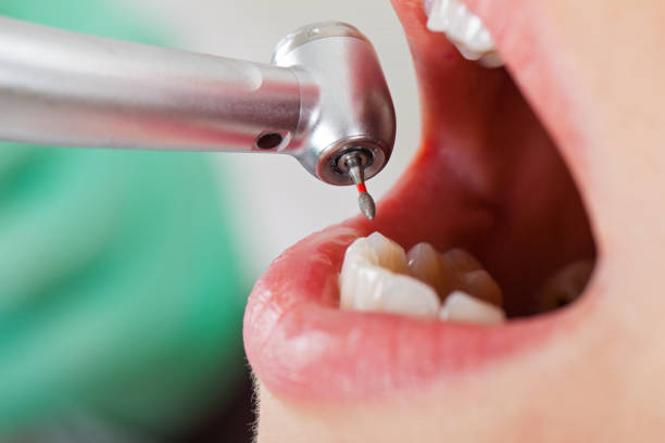 Best Knocked-Out Tooth (Avulsed Tooth) Treatment in Saginaw, MI